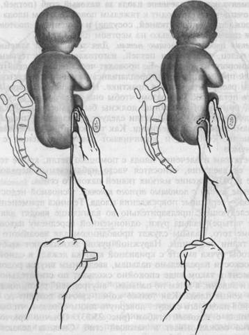 Извлечение плода за тазовый конец - student2.ru