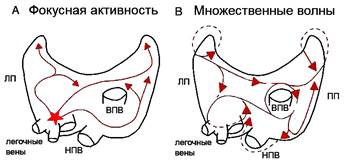 Как объясняет патогенез ФП другая теория? - student2.ru