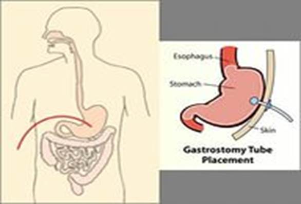 как ухаживать за гастростомой? - student2.ru