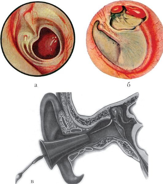 Каков характер перфорации барабанной перепонки при мезо- и эпитимпаните - student2.ru