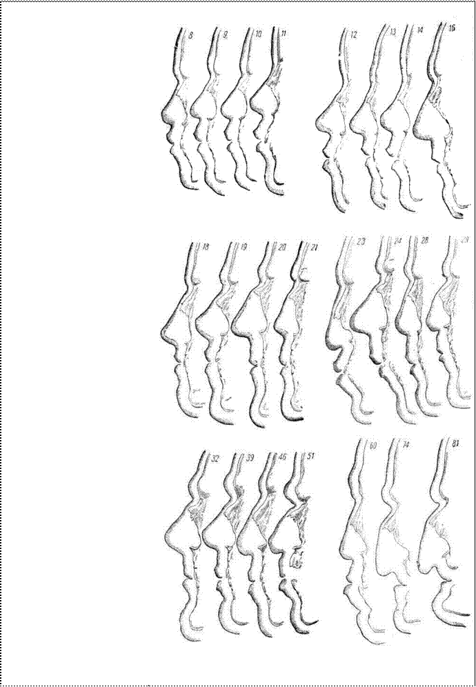 Вариации мягких тканей в связи с профилировкой лица - student2.ru