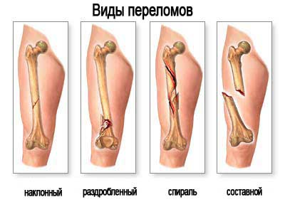 Сдавливание таза в поперечном направлении за большие вертелы Разворачивание таза за гребни подвздошных костей - student2.ru