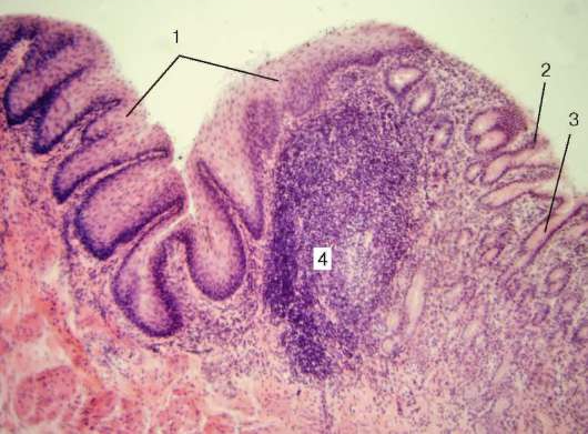 Однослойный столбчатый эпителий; 2 - лимфоидные узелки; 3 - выпячивание - student2.ru