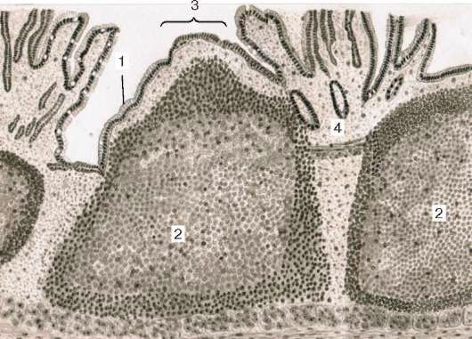 Однослойный столбчатый эпителий; 2 - лимфоидные узелки; 3 - выпячивание - student2.ru