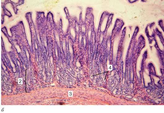 Однослойный столбчатый эпителий; 2 - лимфоидные узелки; 3 - выпячивание - student2.ru