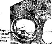 ОВУЛЯЦИЯ. Дистальный конец яйцевода засасывает вторичный ооцит с фолликулярными клетками в свою воронку, неся его в свою ампулу - student2.ru