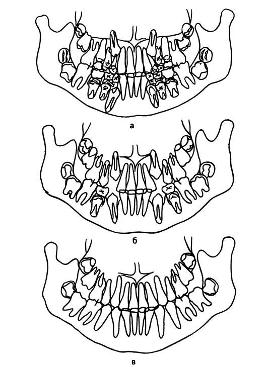 Последовательное удаление отдельных зубов с целью управления прорезыванием остальных показано при следующих условиях - student2.ru