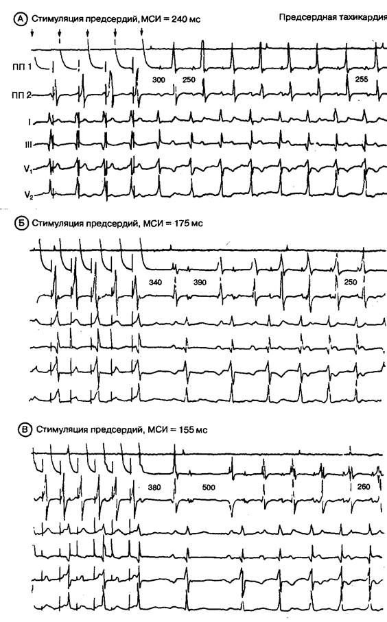 Внутрисердечные ЭФИ у больных с предсердной тахикардией - student2.ru