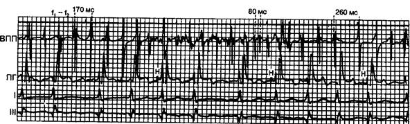 Хаотическая мультифокальная предсердная тахикардия - student2.ru