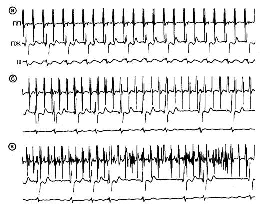 Хаотическая мультифокальная предсердная тахикардия - student2.ru
