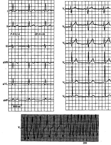 Мерцание предсердий при синдроме ВПУ - student2.ru