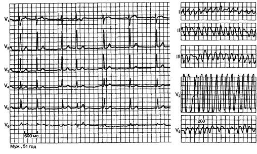 Мерцание предсердий при синдроме ВПУ - student2.ru