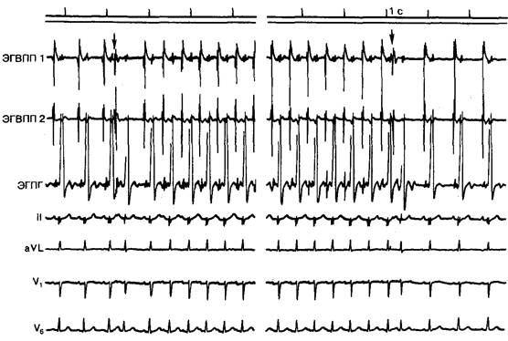 Внутрисердечное электрофизиологическое исследование пароксизмальной синусовой тахикардии - student2.ru