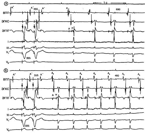Внутрисердечное электрофизиологическое исследование пароксизмальной синусовой тахикардии - student2.ru