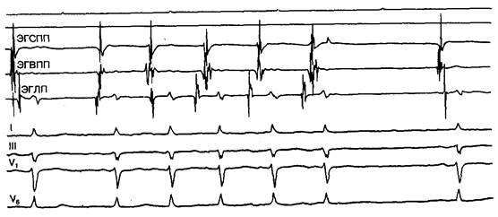 Внутрисердечные ЭФИ у больных с предсердной тахикардией - student2.ru