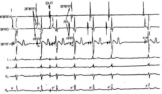 Внутрисердечные ЭФИ у больных с предсердной тахикардией - student2.ru