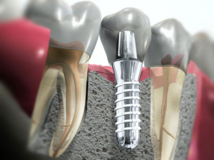 Какие виды несъемных зубных протезов бывают? - student2.ru