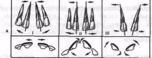 Аномалии положения зубов в трансверсальном направлении - student2.ru
