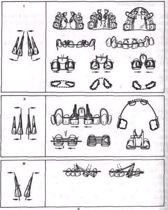 Аномалии положения зубов в трансверсальном направлении - student2.ru