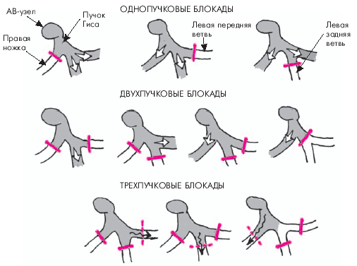 Блокада ножек и ветвей пучка Гиса - student2.ru