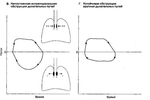 Бронхоплевральный свищ - student2.ru