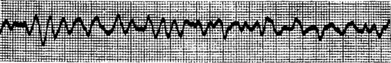 Д. Фибрилляция желудочков - student2.ru
