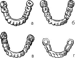 Функционально-направляющие съемные ортодонтические аппараты - student2.ru