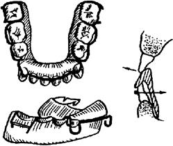 Функционально-направляющие съемные ортодонтические аппараты - student2.ru