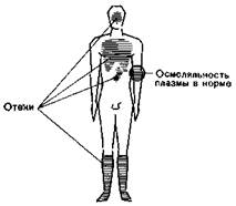 Гипертоническая гипергидратация - student2.ru