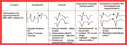 ИБС. Инфаркт миокарда, дифференциальный диагноз. Критерии диагностики инфаркта миокарда с зубцом Q - student2.ru