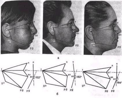 Ис. 5.3. Типы лица при нормальном прикусе по Шварцу - student2.ru