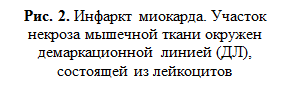 ишемическая болезнь сердца (ибс) - student2.ru