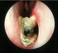 Хронический атрофический ринит (rhinitis atrophica) - student2.ru