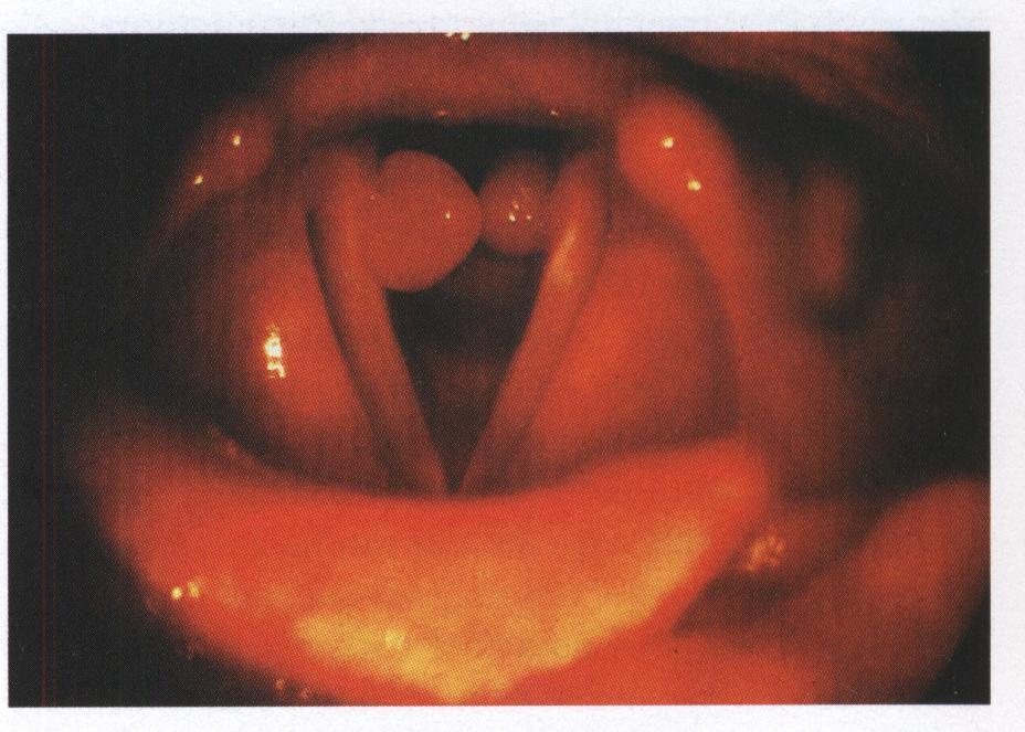 Хронический ларингит (laryngitis chronica) - student2.ru