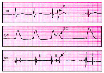 Наджелудочковая (суправентрикулярная) экстрасистолия - student2.ru