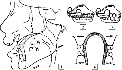 Ортодонтические аппараты комбинированного действия - student2.ru
