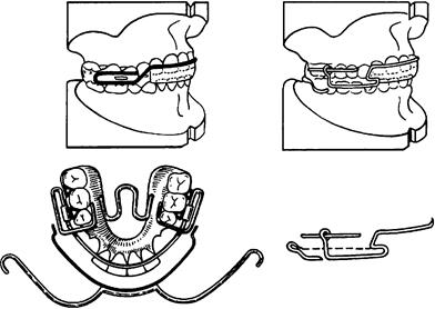 Ортодонтические аппараты комбинированного действия - student2.ru