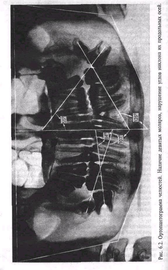Панорамная рентгенография - student2.ru