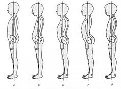 пороки осанки. сколиоз - student2.ru