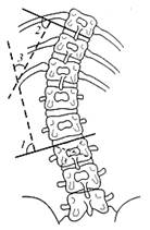 пороки осанки. сколиоз - student2.ru