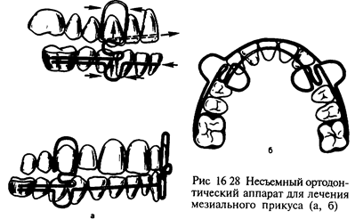 Пружина Коффина, соединяющая небные пластмассовые пелоты. 3 страница - student2.ru