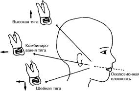 Тема: Внеротовые ортодонтические аппараты - student2.ru