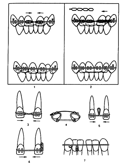 Устранение аномалий положения зубов, нарушений формы и размеров зубных дуг - student2.ru