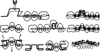 Устранение аномалий положения зубов, нарушений формы и размеров зубных дуг - student2.ru