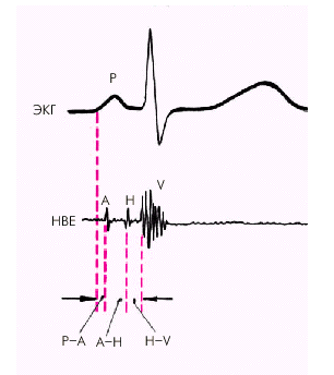 Внутрисердечное электрофизиологическое исследование (ЭФИ) - student2.ru