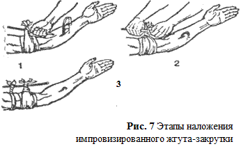 Временная остановка артериального кровотечения максимальным сгибанием конечности - student2.ru