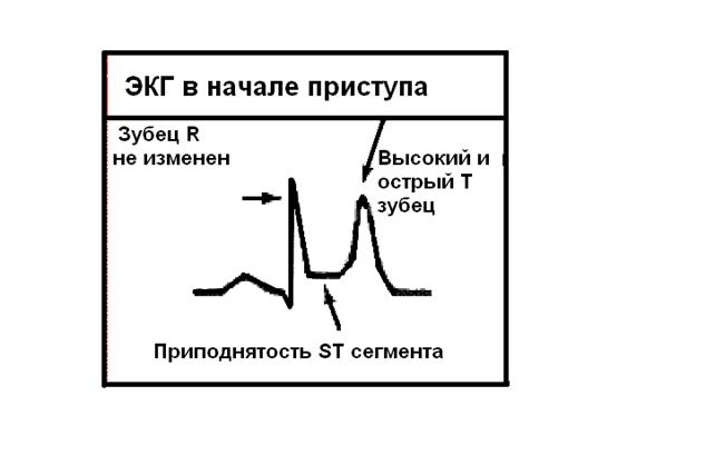 ЭКГ признаки гипертрофии левого предсердия - student2.ru