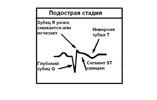 ЭКГ признаки гипертрофии левого предсердия - student2.ru