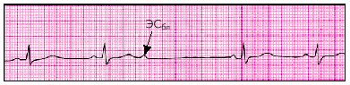 Экстрасистолы из АВ-соединения - student2.ru