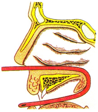 Заболевания полости носа - student2.ru